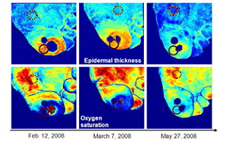 Diabetes Foot Ulcer Diagnosis and Treatment Could Be Improved and Made Earlier with Hyperspectral Imaging Techniques