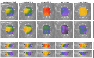 UCLA Study Reveals Complex Muscle Control Behind Blinking and Eyelid Function